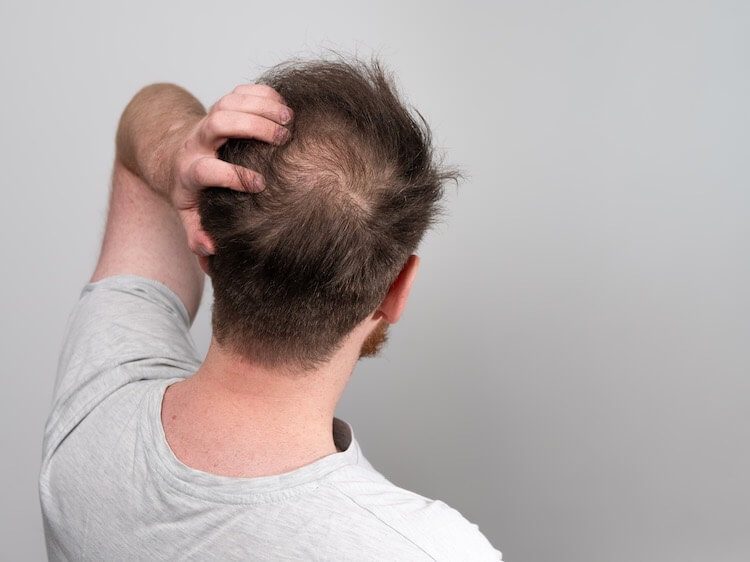 Causes of Hair Fall Causes of Hair Fall